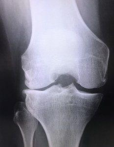 痛みのある膝関節